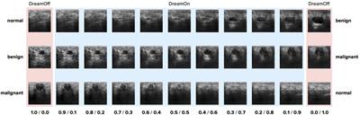 DreamOn: a data augmentation strategy to narrow the robustness gap between expert radiologists and deep learning classifiers